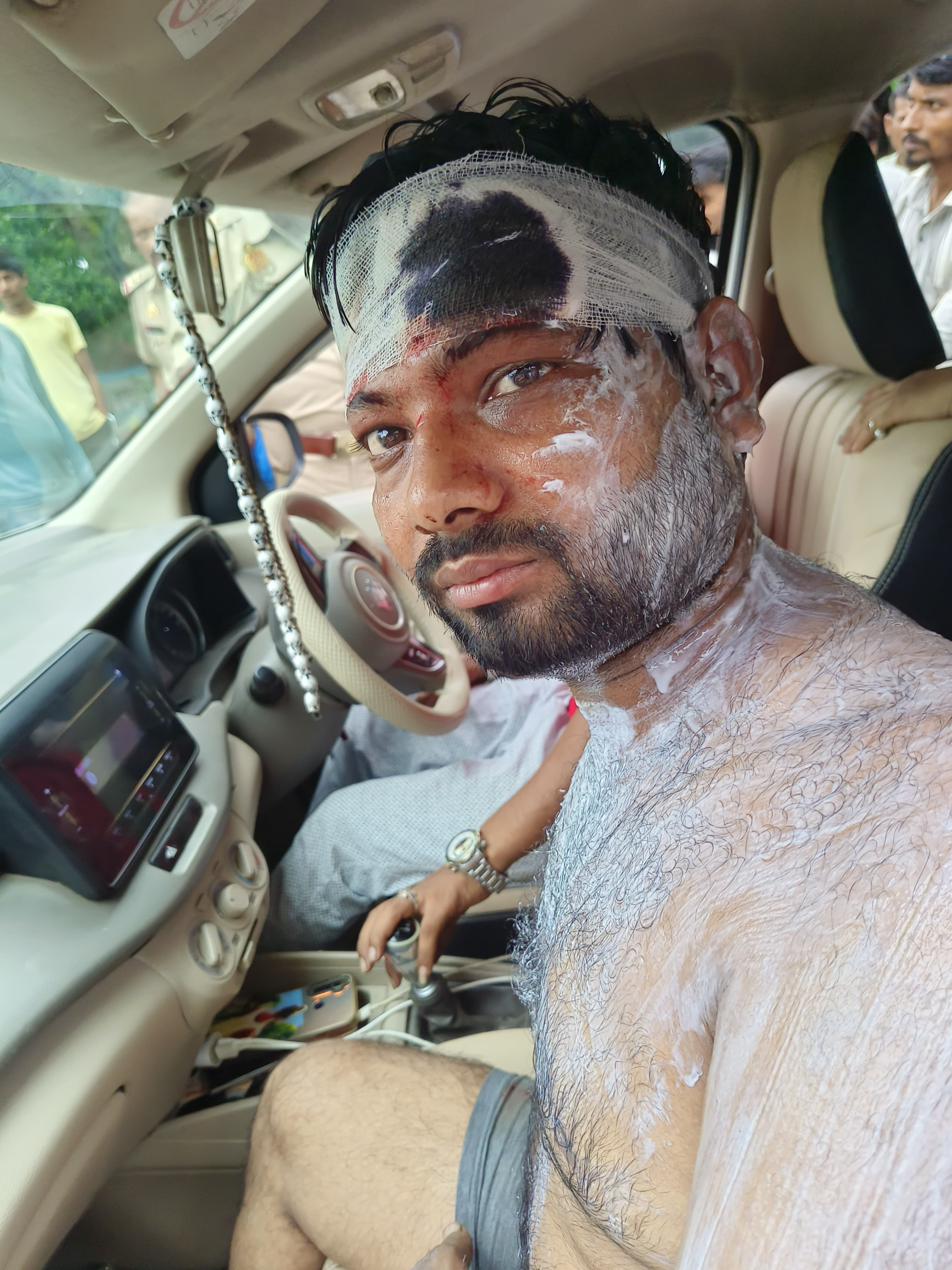 दहेज विवाद के बीच तेजाब हमला चार लोग गंभीर रूप से झुलसे 